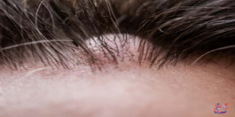 ما الفرق بين الكيس الدهني والورم وكيف يمكن تشخيصهما؟