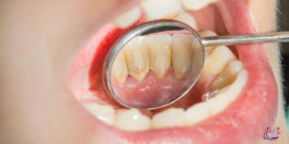 أفضل طريقة للتخلص من جير الأسنان