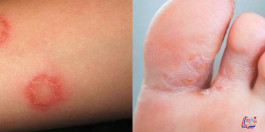 علاج التينيا بكل الطرق الممكنة والوقاية منها