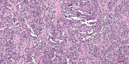 الساركوما العضلية المخططة Rhabdomyosarcoma