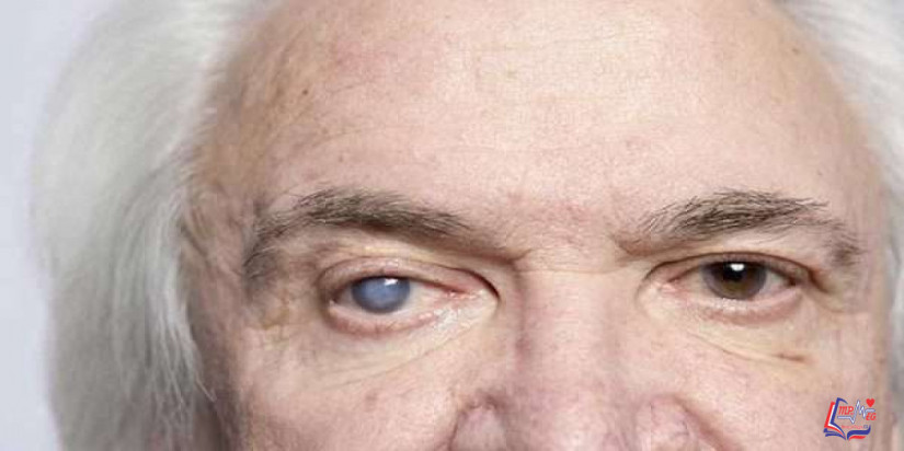 خطورة المياه البيضاء على العين .. وهذه هي الأعراض