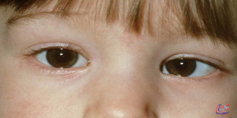 ما هو الحول الكاذب عند الاطفال ؟