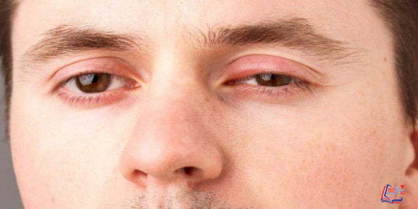 علاج انتفاخ جفن العين العلوي والسفلي بعلاجات منزلية وأخرى طبية