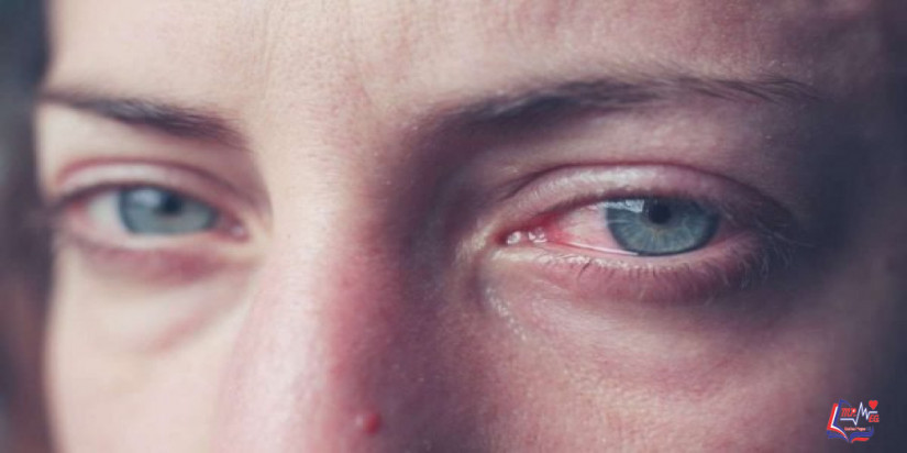 علاج احمرار العين: حلول قصيرة الأجل وطويلة الأجل لعلاج احمرار العين