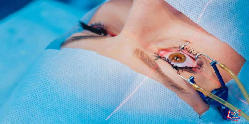 الليزك السطحى .. الخطوات والمميزات والعيوب والآثار الجانبية