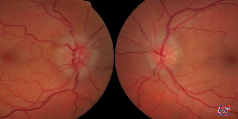 زراعة العصب البصري .. هل هي ممكنة؟ تعرف على الإجابة