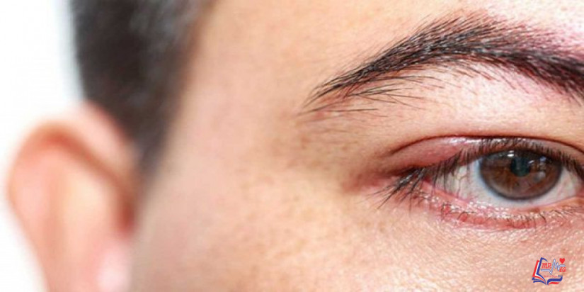 خراج العين .. أسبابه وأعراضه وكيفية تشخيصه وعلاجه!