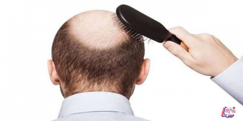 تساقط الشعر عند الرجال أسبابه و الحلول