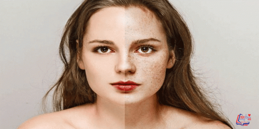 علاج النمش بالطرق المختلفة .. وهل له علاجات منزلية؟!