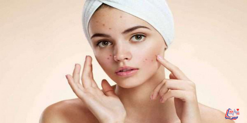 التخلص من حب الشباب يبدأ بالابتعاد عن هذه العادات الثمانية !!