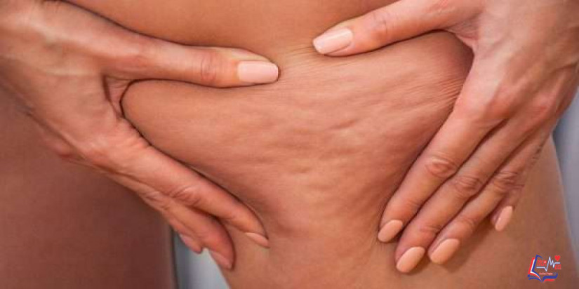 اسباب السيلوليت أو متلازمة قشرة البرتقال وكيفية التخلص من هذه المشكلة