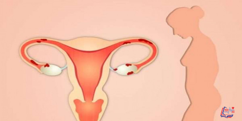 التهاب عنق الرحم والجماع .. هل يؤثر التهاب عنق الرحم على الجنس؟