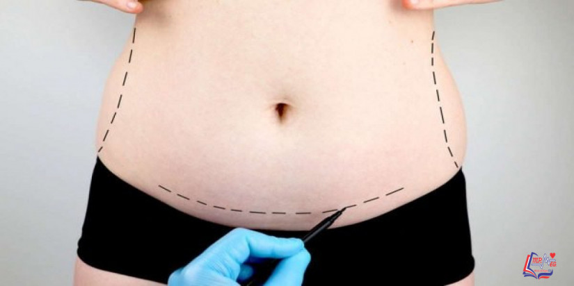 شفط دهون البطن بالليزر .. كل ما يهمك من معلومات