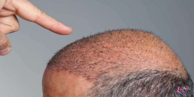 ما أسباب تكون القشور بعد زراعة الشعر ؟ وكيف يمكن علاج المشكلة؟