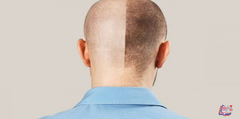 ما هي النتائج المتوقعة بعد زراعة الشعر بشهر ؟