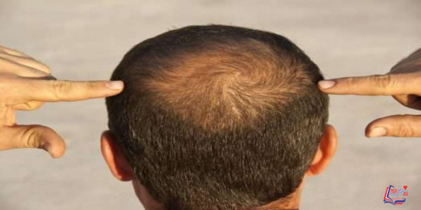 اضرار زراعة الشعر وخطواتها.. ونصائح هامة للتعافي بعد العملية