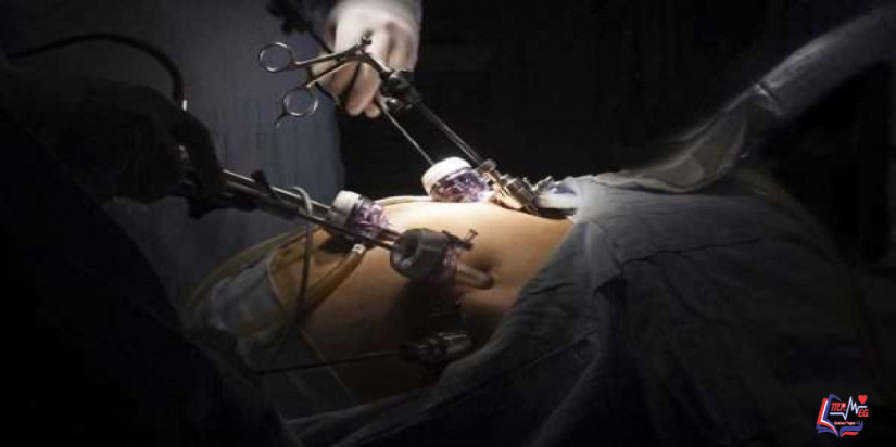 مخاطر عملية تكميم المعدة .. ومن هم المرشحون للعملية؟