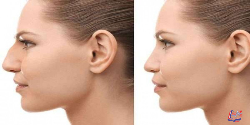 متى يستقر شكل الانف بعد عملية التجميل ؟ وهل هناك مخاطر؟