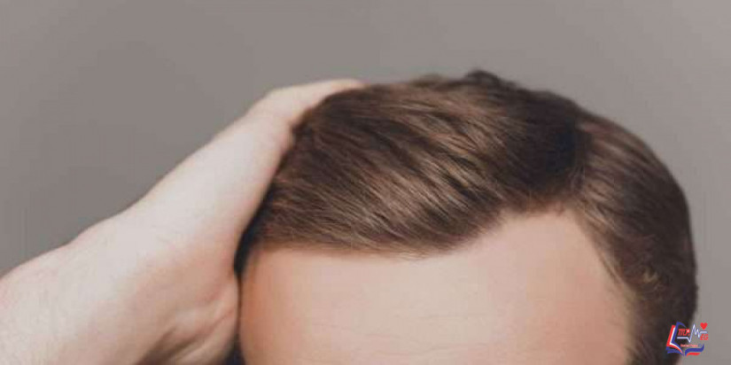 نصائح بعد زراعة الشعر للتعافي بشكل أفضل.. وما هي أنواعها؟