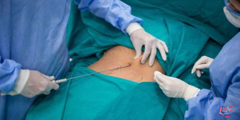 اسعار عمليات شفط الدهون وأنواعها وتقنياتها المختلفة