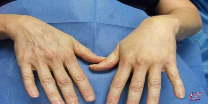 كل ما يهمك معرفته عن عملية حقن اليدين بالدهون الذاتيه التجميلية