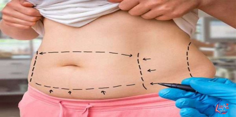 تكلفة عملية شد البطن للتخلص من الترهل والجلد الزائد