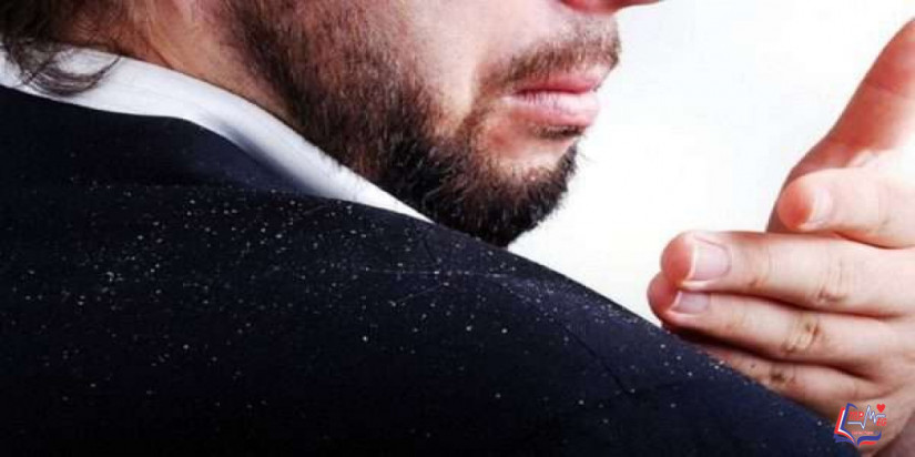 علاج قشرة الشعر الدهني .. لماذا الرجال أكثر عُرضة للإصابة بها؟