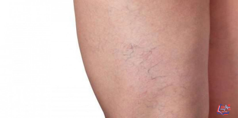 علاج دوالي الساقين بالليزر وأنواعه وخطواته وهل له مخاطر؟