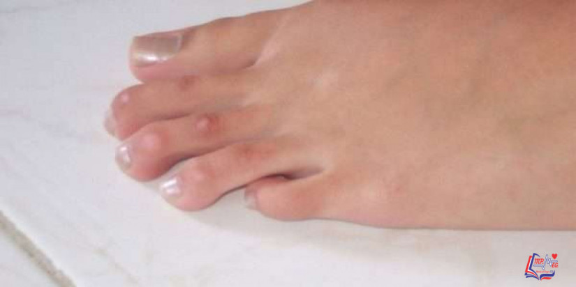 عملية تجميل اصابع القدم وأنواعها للتخلص من تشوهات الأصابع
