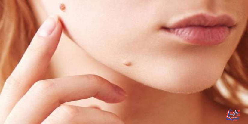 ازالة الشامة بالليزر متى تصبح ضرورية؟ وكيف تتم؟ وما تكلفتها؟