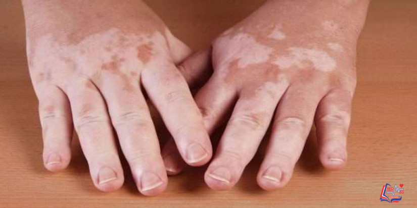 علاج البهاق بعدة طرق جراحياً وموضعياً وبالضوء