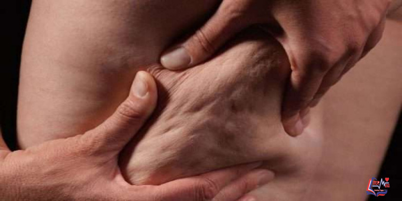 علاج السيلوليت بالليزر .. أهم المعلومات!