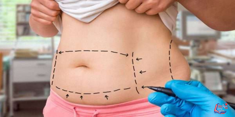 عملية شد البطن ما هي مميزاتها وعيوبها وتكلفتها؟