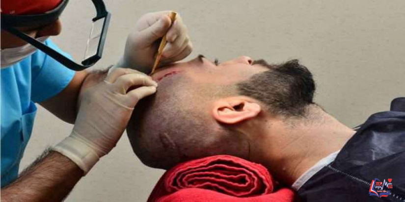 زراعة الشعر بالاقتطاف FUE وأنواعها