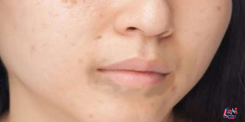 علاج السواد حول الفم .. طرق مختلفة لتتخلصي من هذا الإزعاج