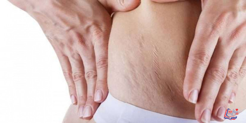 علامات تمدد الجلد وأسبابها وطرق التخلص منها سريعاً