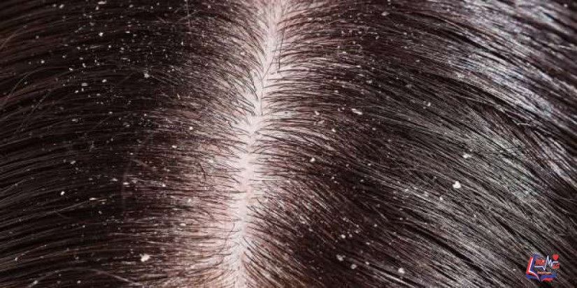 قشرة الشعر وملف شامل عن طرق علاجها