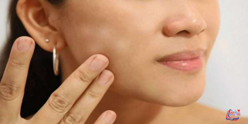 ازالة بقع الوجه بالأدوية والطرق الطبيعية والوقاية منها