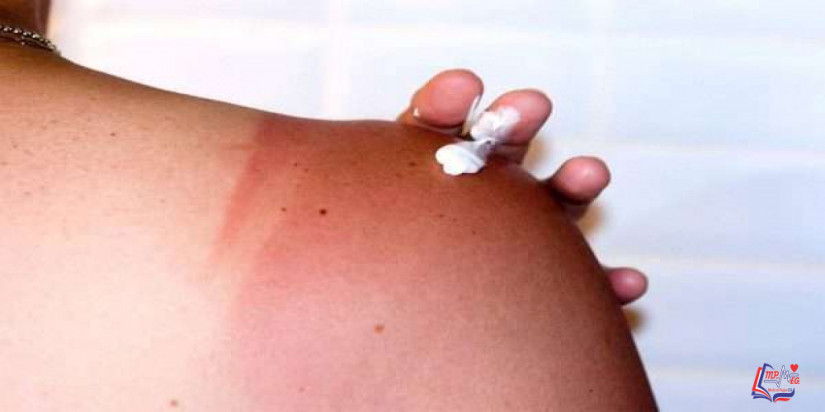 علاج حروق الشمس و أعراض الحروق و كيفية تجنبها