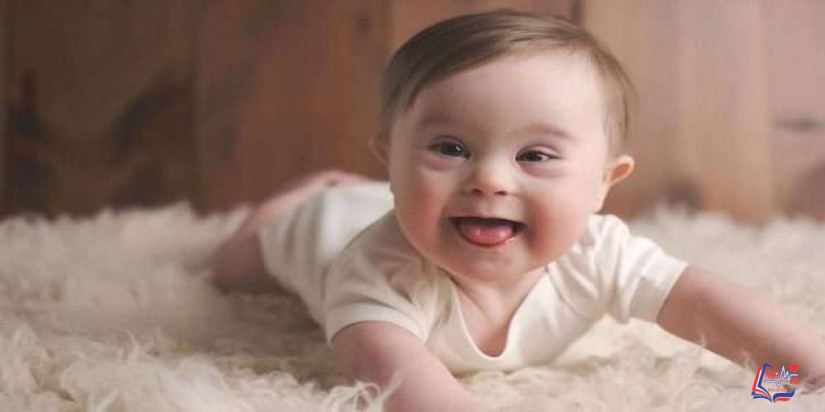 أسباب ولادة طفل منغولي