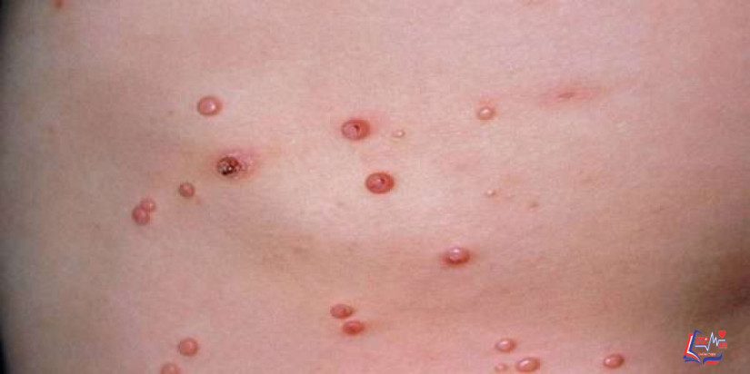 المليساء المعدية في الأطفال.. كيف يتم الإصابة بها؟ ونصائح مهمة للوقاية