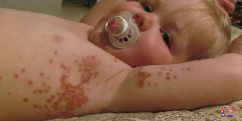 القوباء عند الاطفال : أعراضه وأسبابه وطرق علاجه