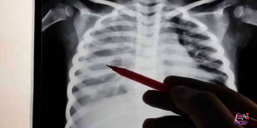 اضرار الاشعة السينية على الاطفال وطرق تقليل مخاطرها