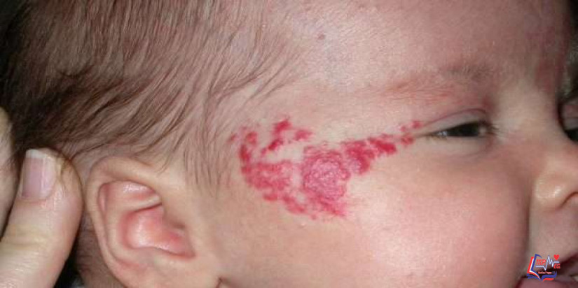 الوحمة الدموية في الأطفال.. كيف يمكن علاج هذه المشكلة؟