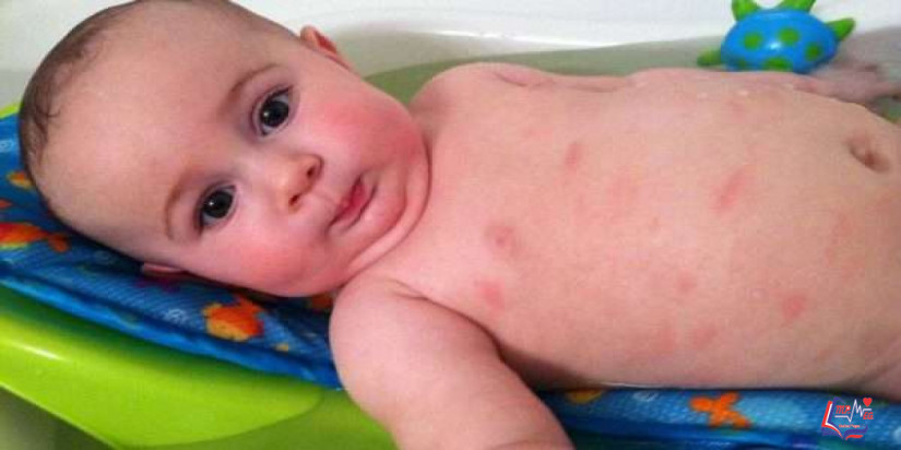 الاكزيما هل يمكنها أن تصيب طفلي وماهي أعراضها ؟