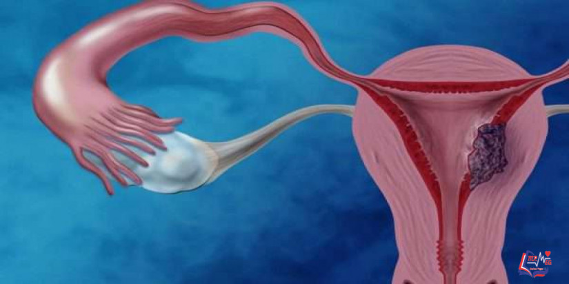 أسباب سرطان الرحم