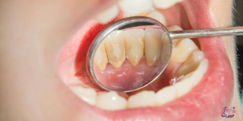 علاج جير الأسنان