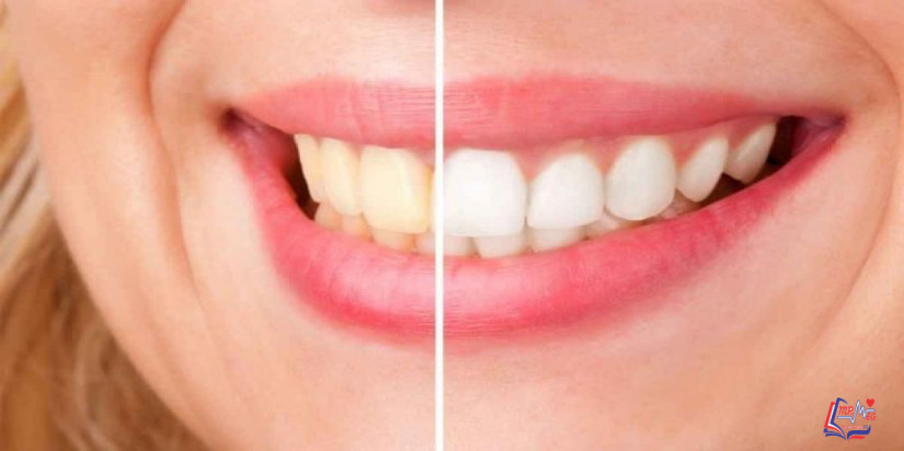 كيف أزيل صفار الأسنان