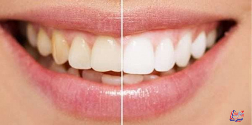 هل إزالة الجير من الأسنان مؤلم؟