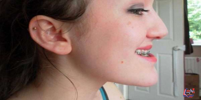 مشكلة اعوجاج الأسنان وعلاجها